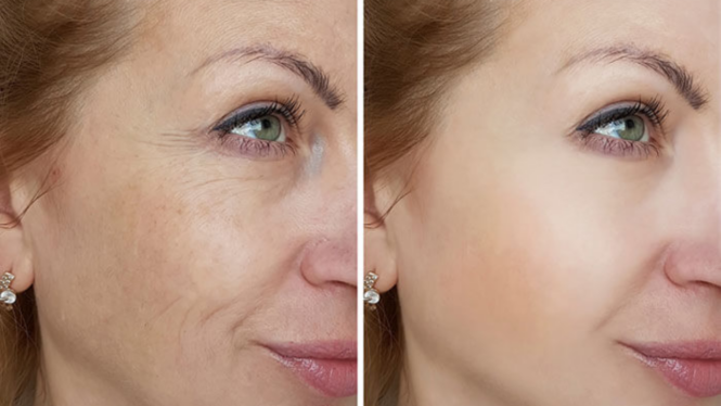 Benefits of Microneedling